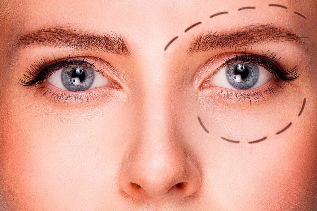 How Long Does Ptosis Surgery Last? Health Online Degree